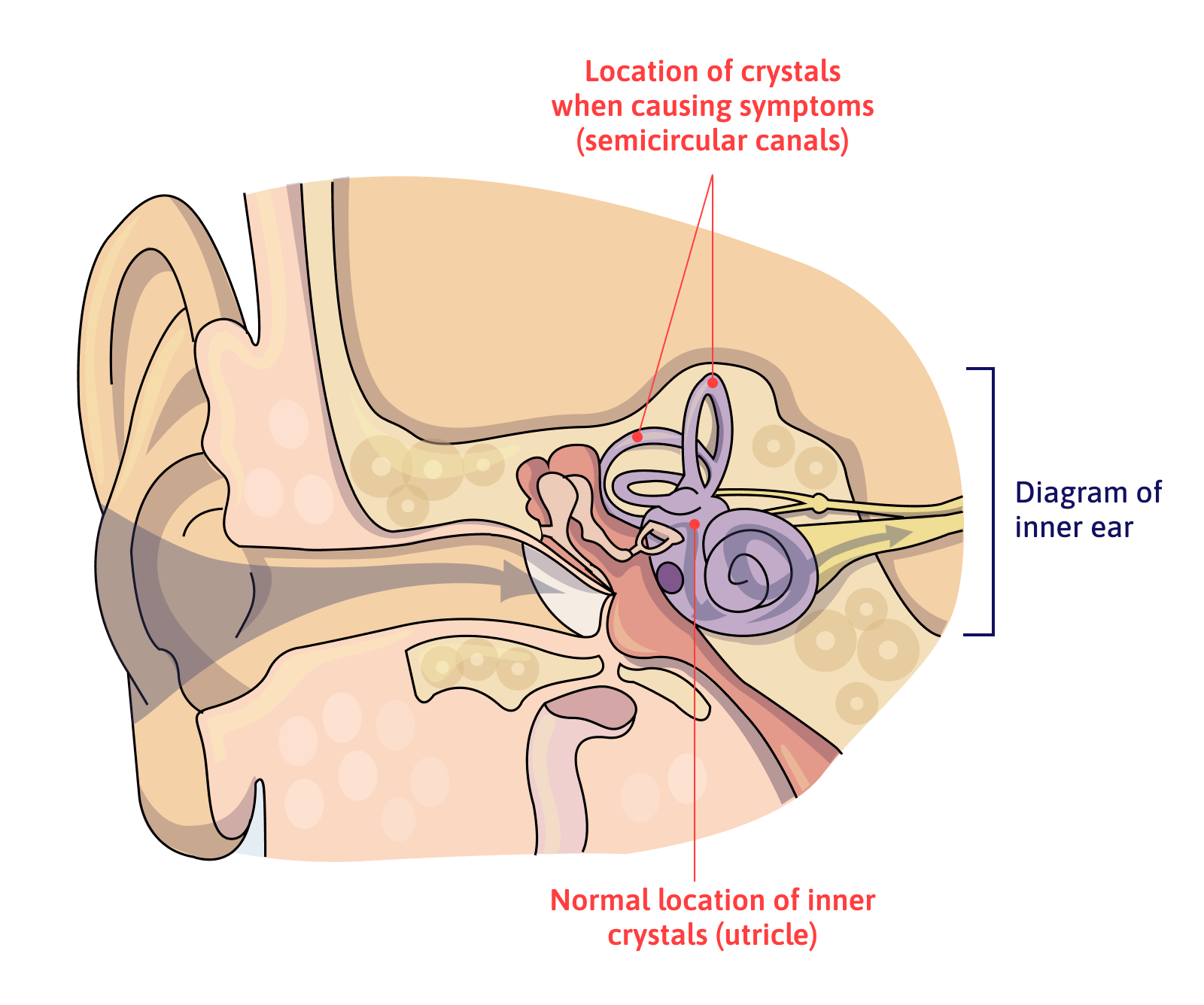 Crystals are located at the top of the canal semicircles when symptoms are present, normal location is at the bottom.