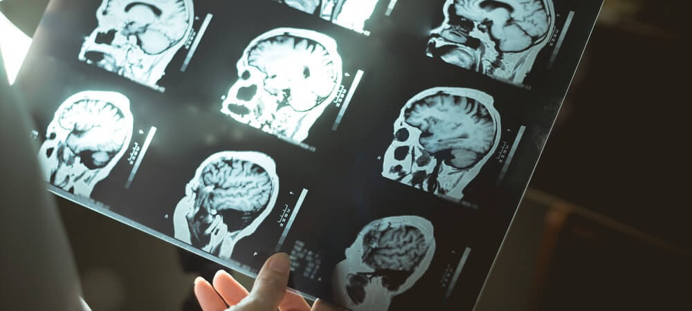 Neuroimaging Results